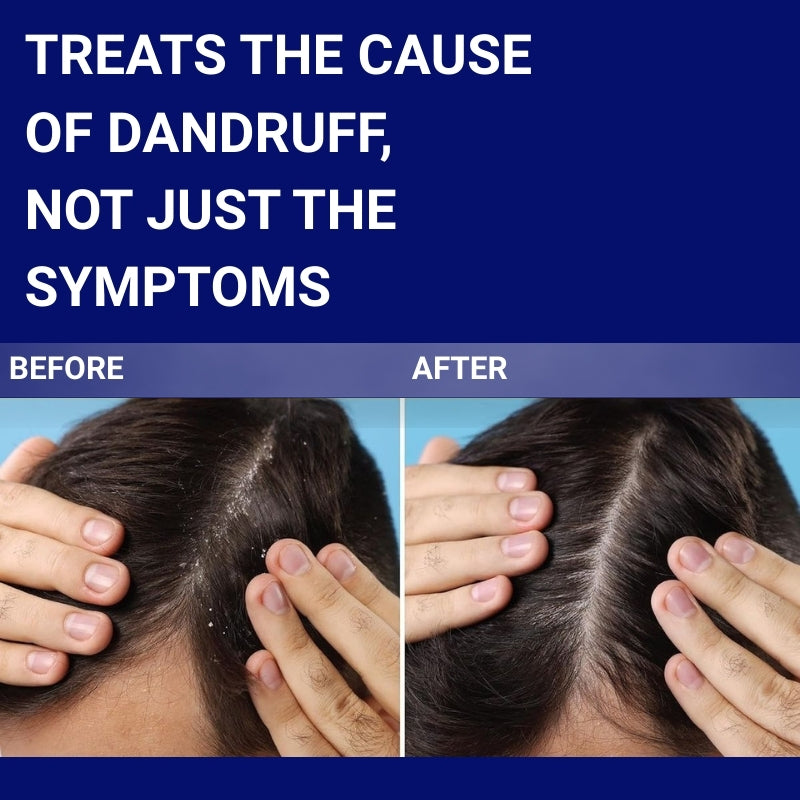 Sebizole 2% Anti-Dandruff Shampoo, 100ml