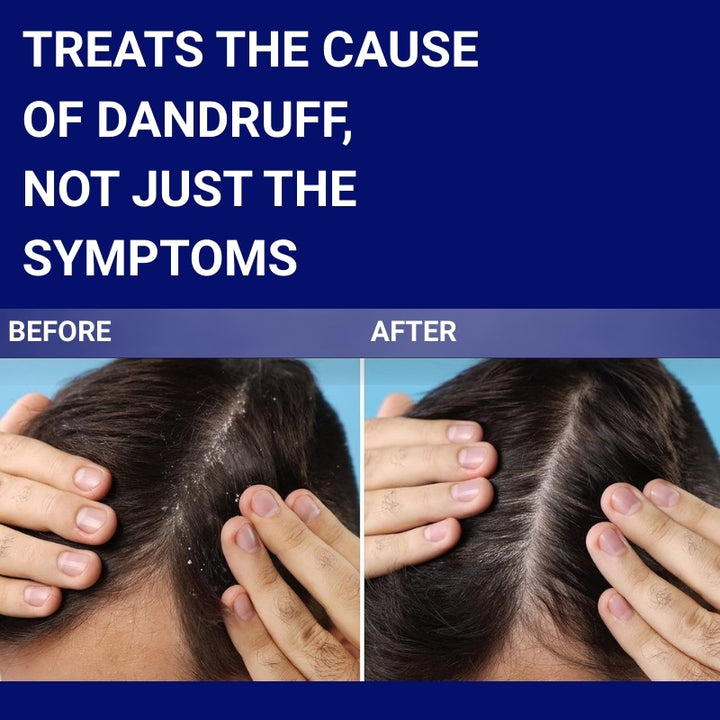 Sebizole 2% Anti-Dandruff Shampoo, 100ml