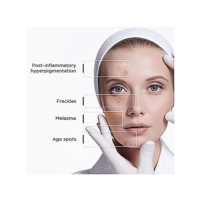 Woman's face with skin conditions labeled on a white background