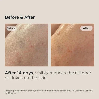 Before and after images showing reduced skin flakes after 14 days using ISDIN Hydration Ultra10 Repairing Lotion Plus